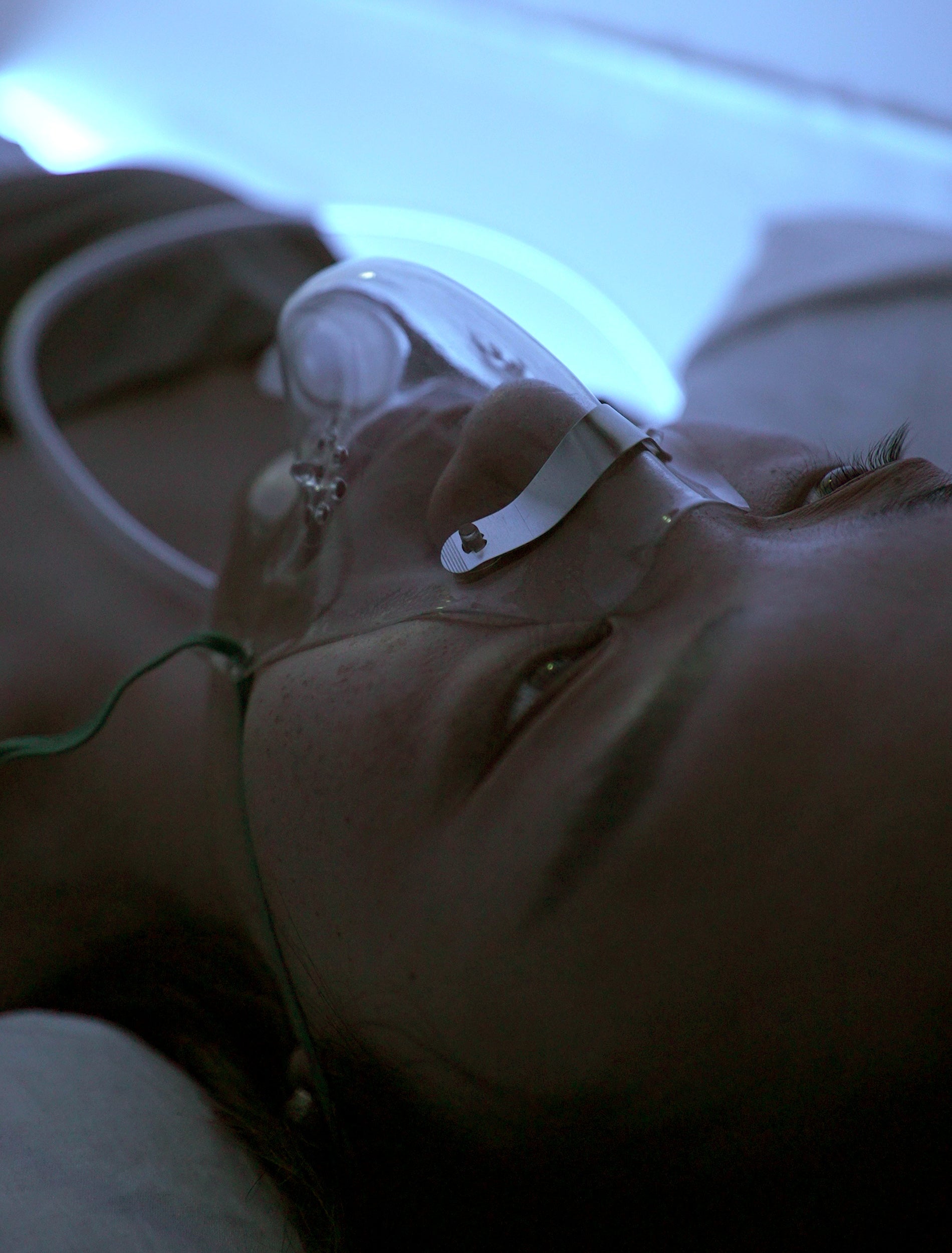 Hyperbaric Oxygen
